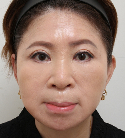 Before Image