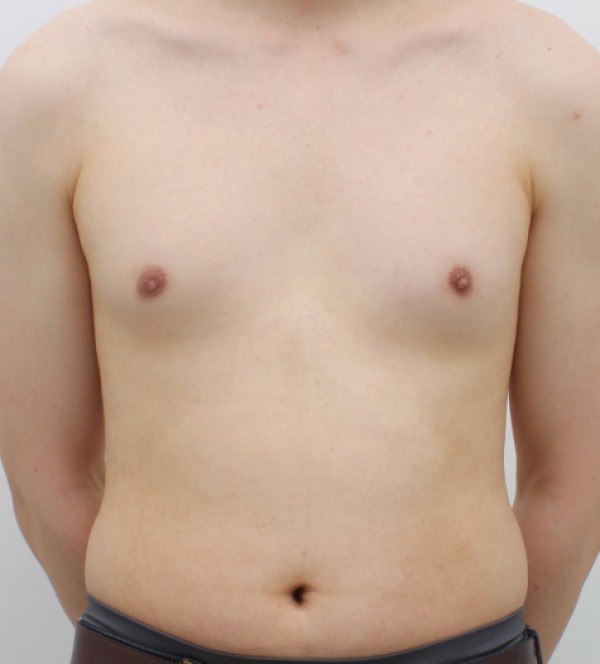 女性化乳房