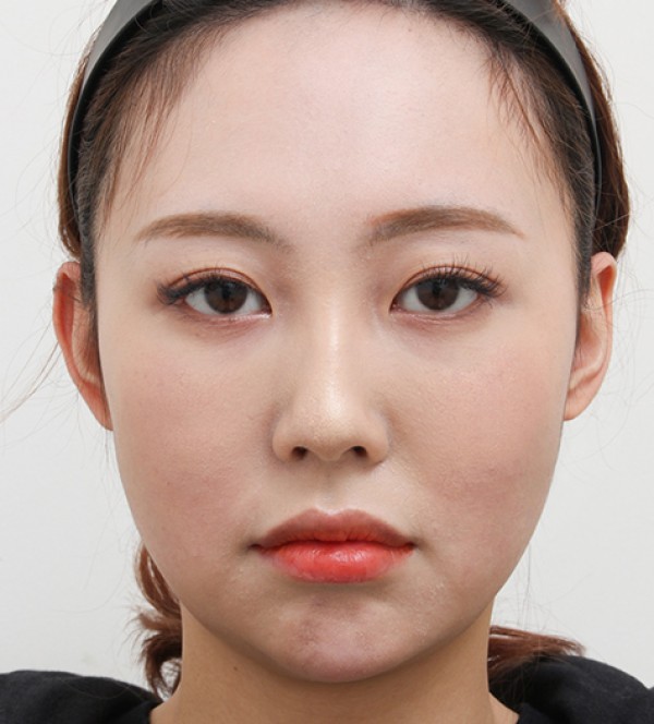 顔の脂肪吸引