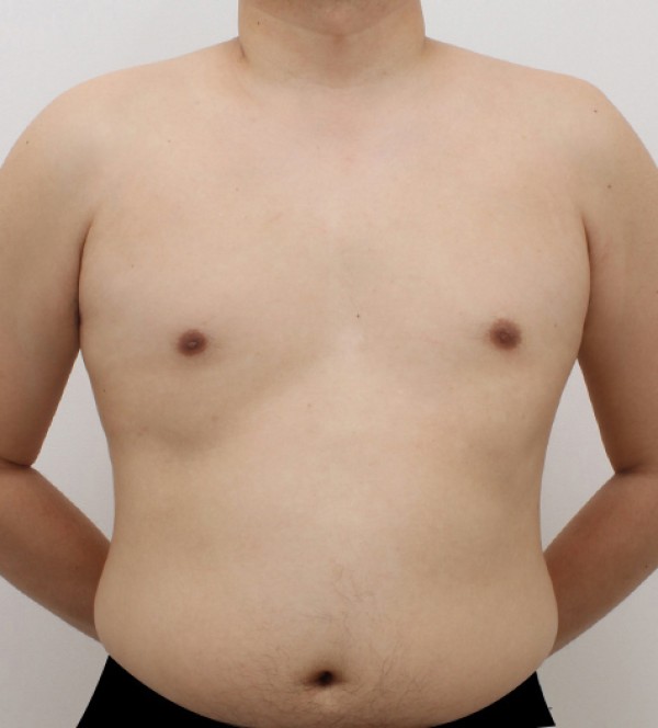 女性化乳房