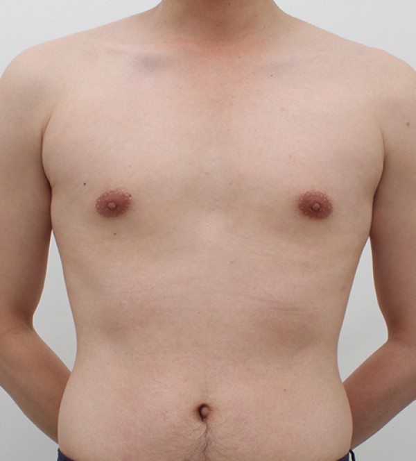 女性化乳房