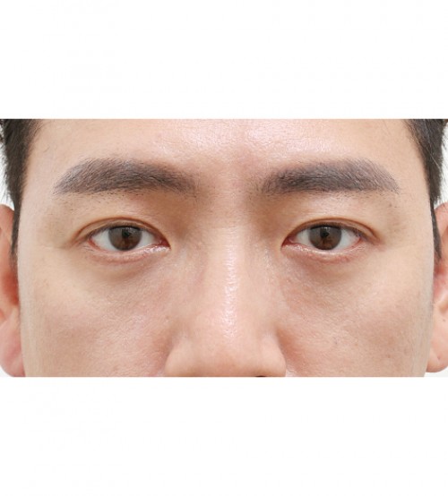 レーザー裏ハムラ法