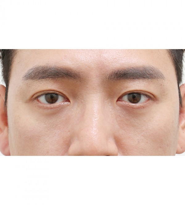 レーザー裏ハムラ…