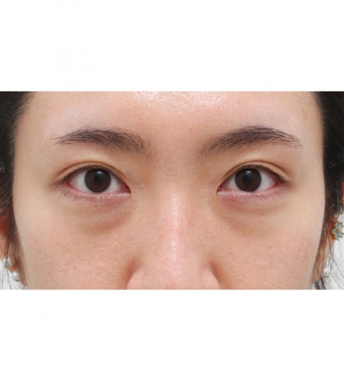 レーザー裏ハムラ法