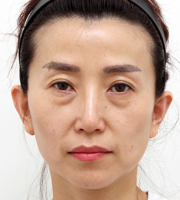 シニア脂肪注入