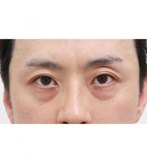 レーザー裏ハムラ法