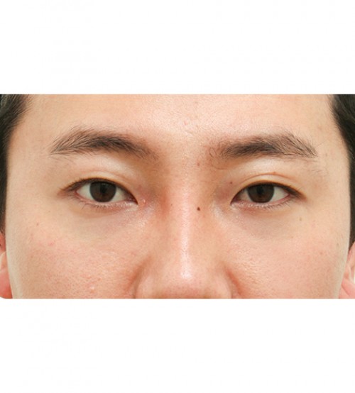 レーザー裏ハムラ法