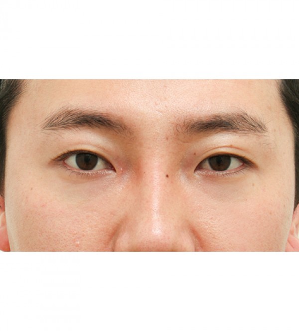 レーザー裏ハムラ…