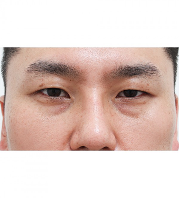 レーザー裏ハムラ…