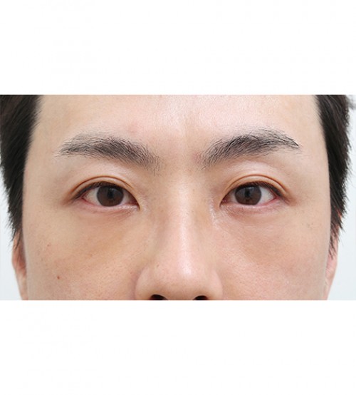 レーザー裏ハムラ法