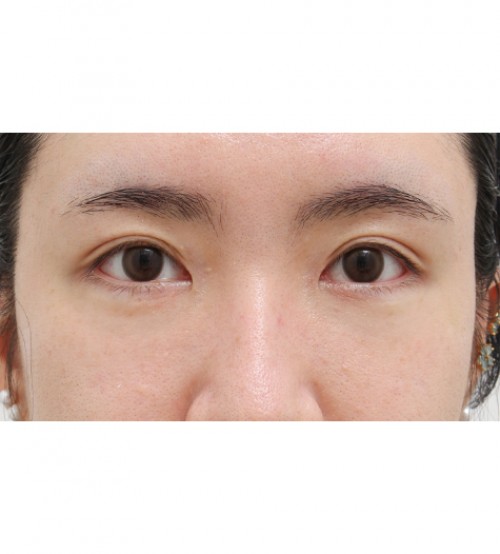 レーザー裏ハムラ法