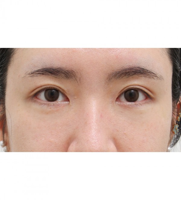 レーザー裏ハムラ…