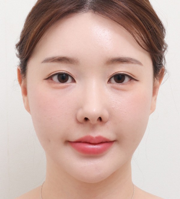 顔の脂肪吸引