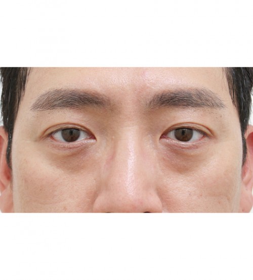 レーザー裏ハムラ法