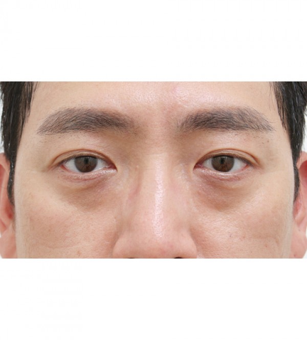 レーザー裏ハムラ…