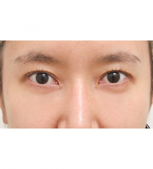 レーザー裏ハムラ法