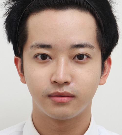 顔の脂肪注入