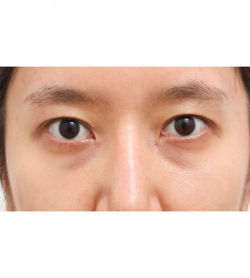 レーザー裏ハムラ法