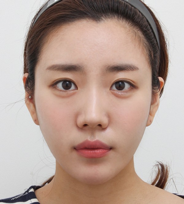 顔の脂肪吸引
