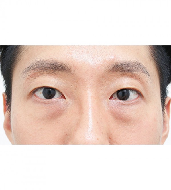 レーザー裏ハムラ…