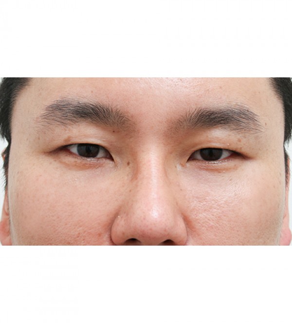 レーザー裏ハムラ…