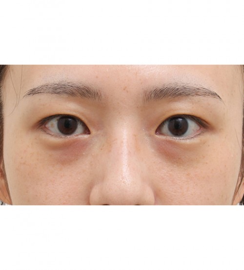 レーザー裏ハムラ法