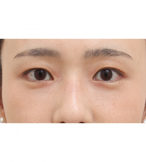 レーザー裏ハムラ法