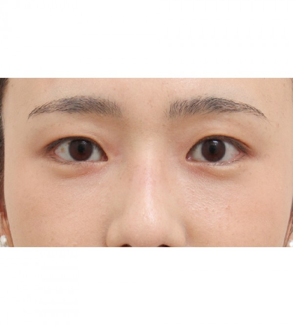 レーザー裏ハムラ…