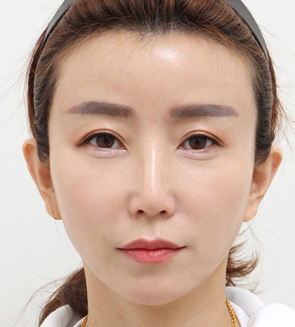 シニア脂肪注入