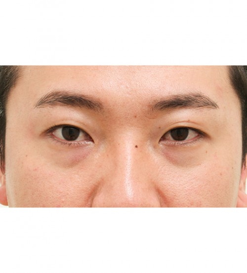 レーザー裏ハムラ法