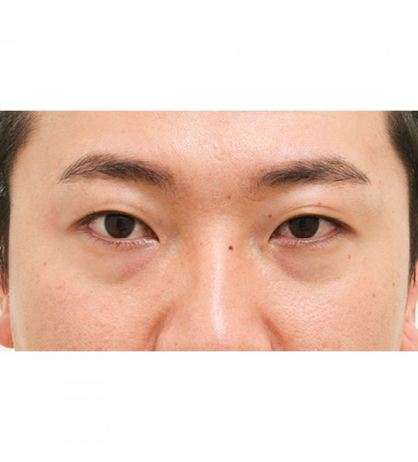 レーザー裏ハムラ…