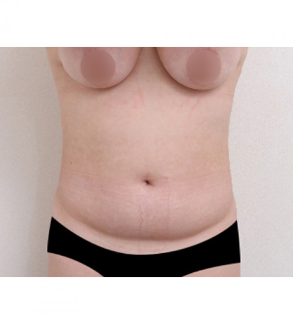 ベイザー2ボディ…