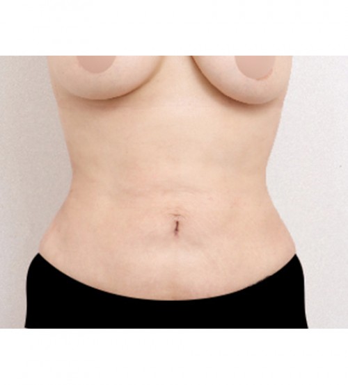 ベイザー2ボディ脂肪吸引