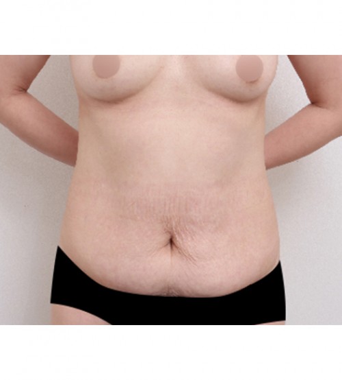 腹部リダクション