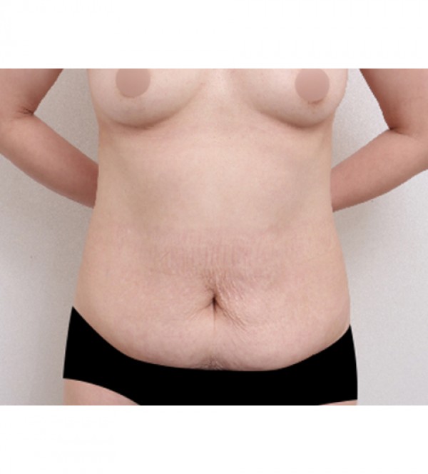 腹部リダクション