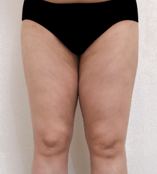 ベイザー2ボディ…