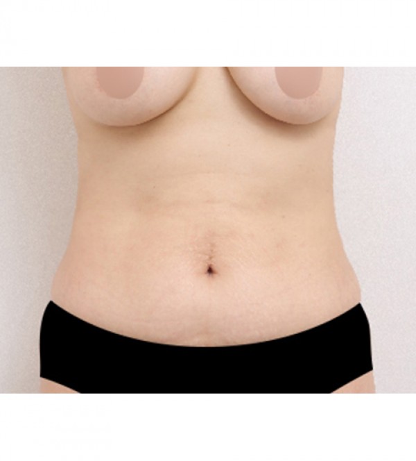 ベイザー2ボディ…