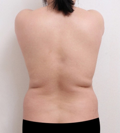 ベイザー2ボディ脂肪吸引