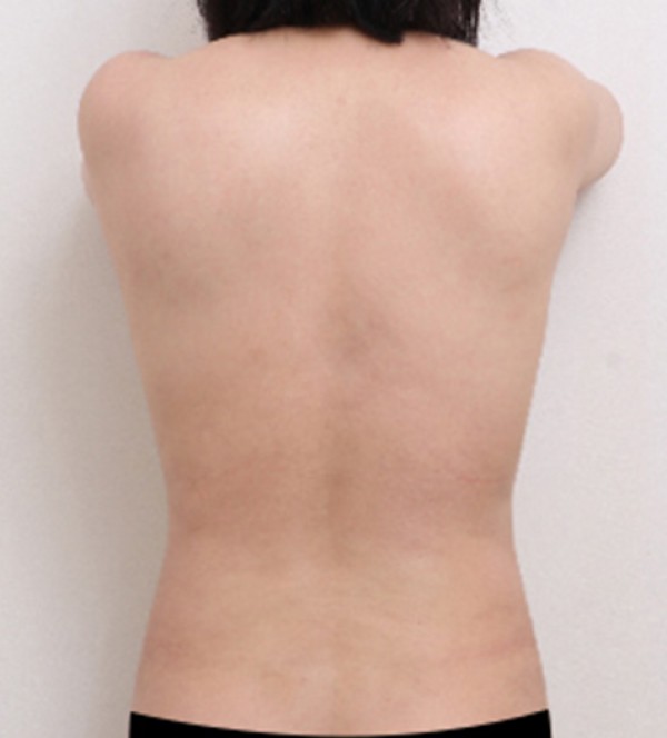 ベイザー2ボディ…