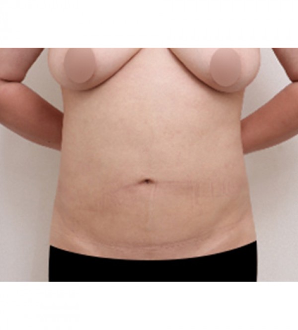 ベイザー2ボディ…