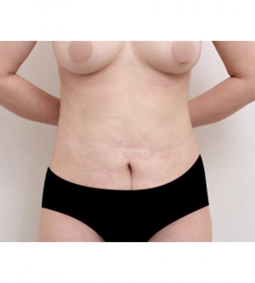 腹部リダクション