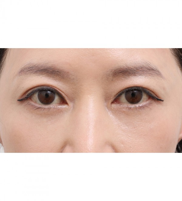 レーザー目の下の…