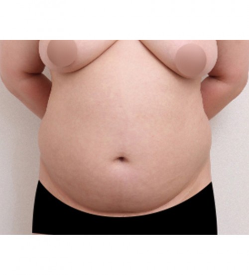 ベイザー2ボディ脂肪吸引