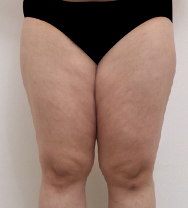 ベイザー2ボディ…