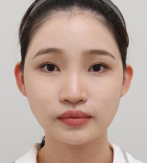 顔の脂肪注入