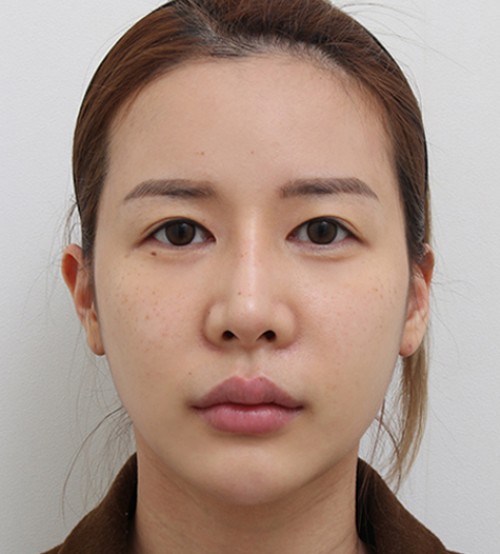 顔の脂肪注入
