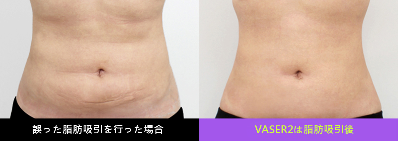 腹部リダクション