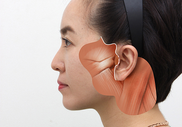 일반적인 캐뉼라 이미지