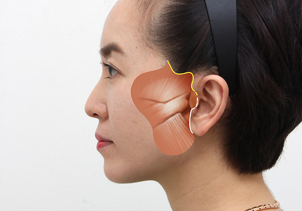 프레쉬 나노 캐뉼라 이미지