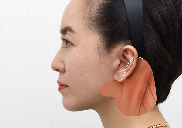 일반적인 캐뉼라 이미지